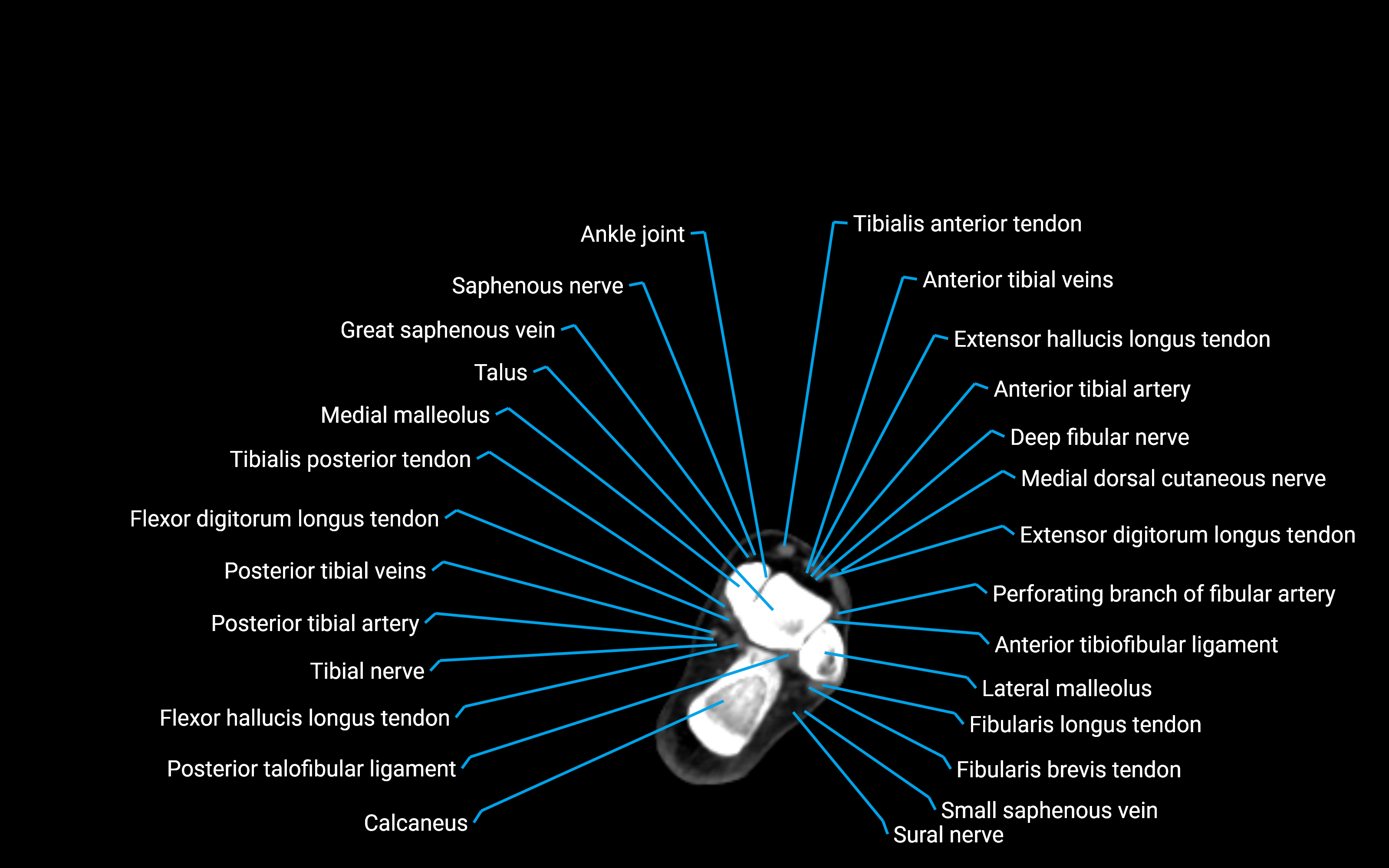 CT Lower leg axial cross sectional anatomy labelled image 167 (2).png